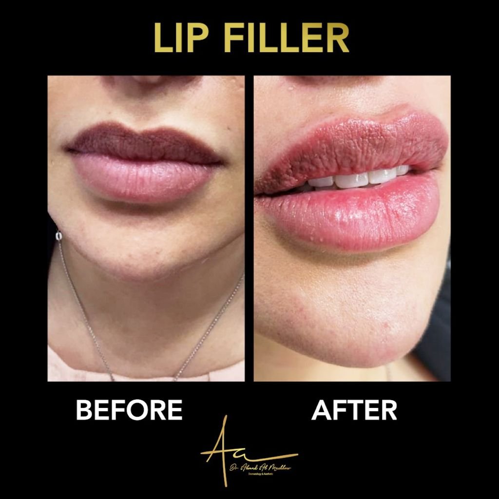 Lip filler Lip filler