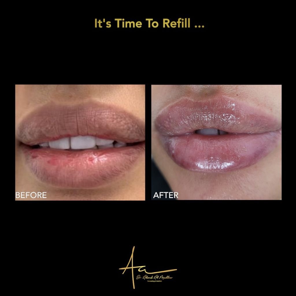 Lip filler Lip filler