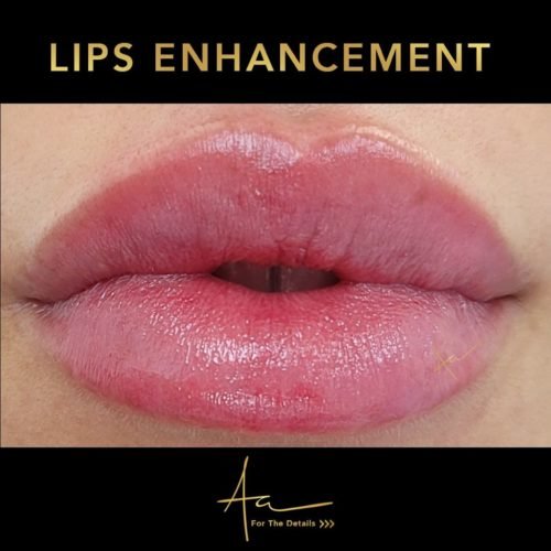 Lip filler Lip filler